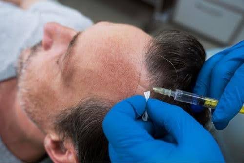 is hair transplant safe